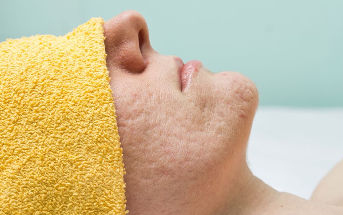 Trattamento cicatrici da acne