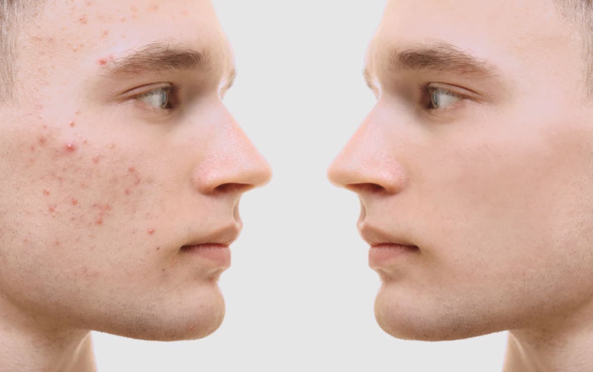 Trattamento dell'acne